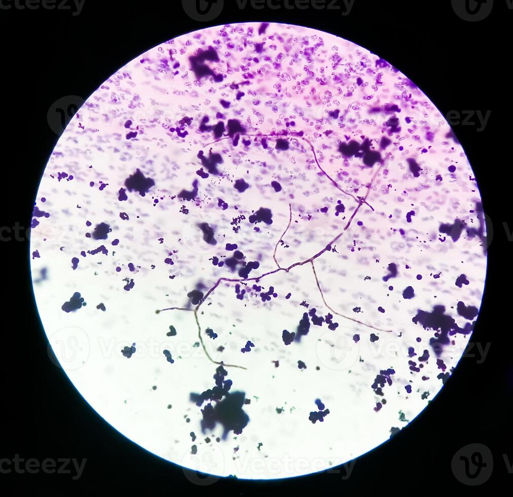 Photomicrograph of Paps Smear. Inflammatory smear with vaginal candidiasis . Medical concept. photo