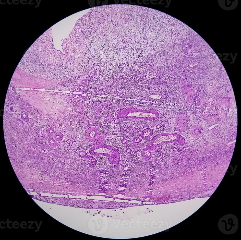 Histology, Peritoneal inclusion cyst. Paraovarian cysts, hydrosalpinx and low-grade cystic mesothelioma are usually considered in the differential diagnosis of PICs. photo