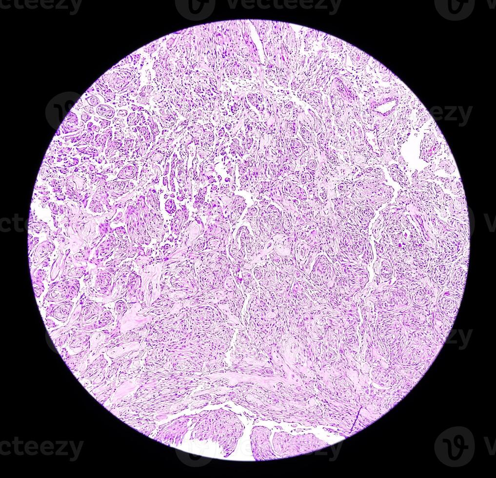 Photomicrograph of histological slide showing Lobular capillary hemangioma on finger. photo