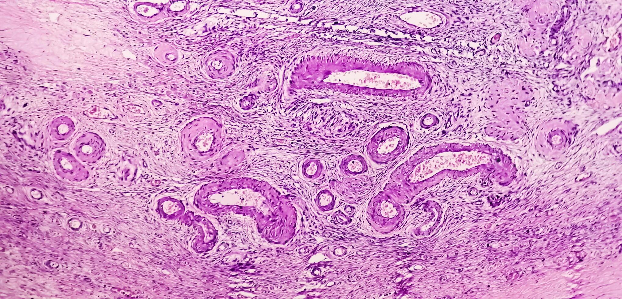 Histology, Peritoneal inclusion cyst. Paraovarian cysts, hydrosalpinx and low-grade cystic mesothelioma are usually considered in the differential diagnosis of PICs. photo