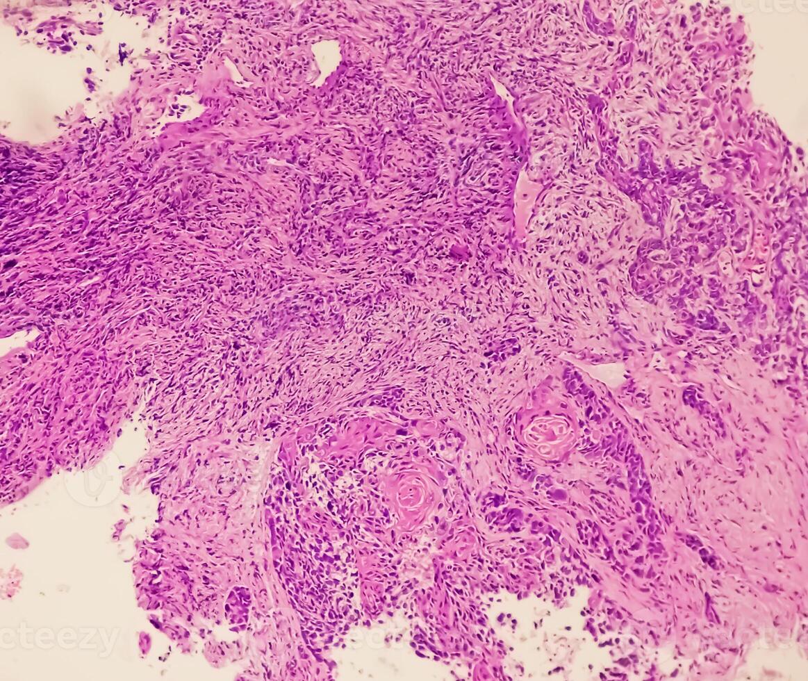 Histological Photomicrograph. Prurigo nodularis or PN is a chronic disorder of the skin. photo