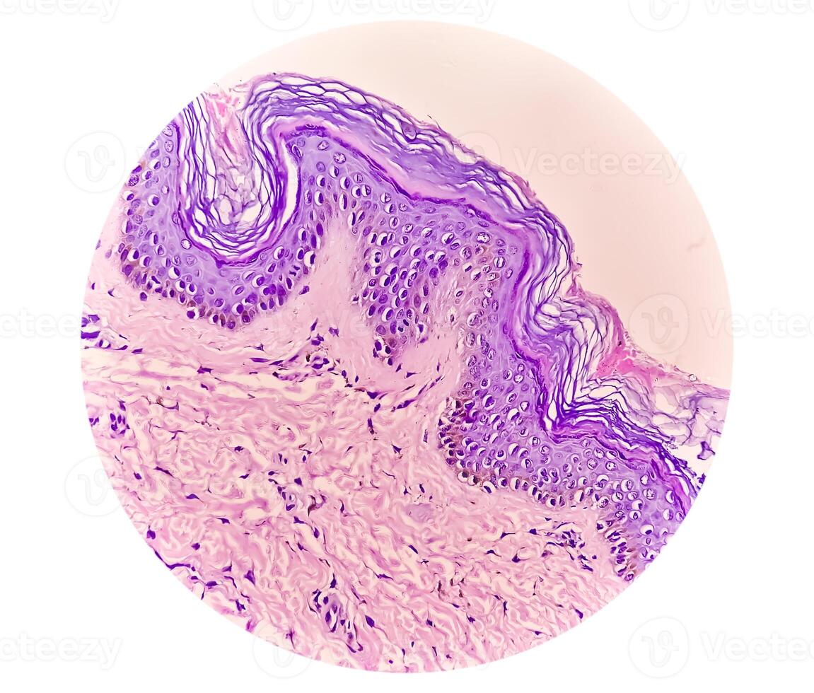 histológico fotomicrografía. prurigo nodular o pn es un crónico trastorno de el piel. foto
