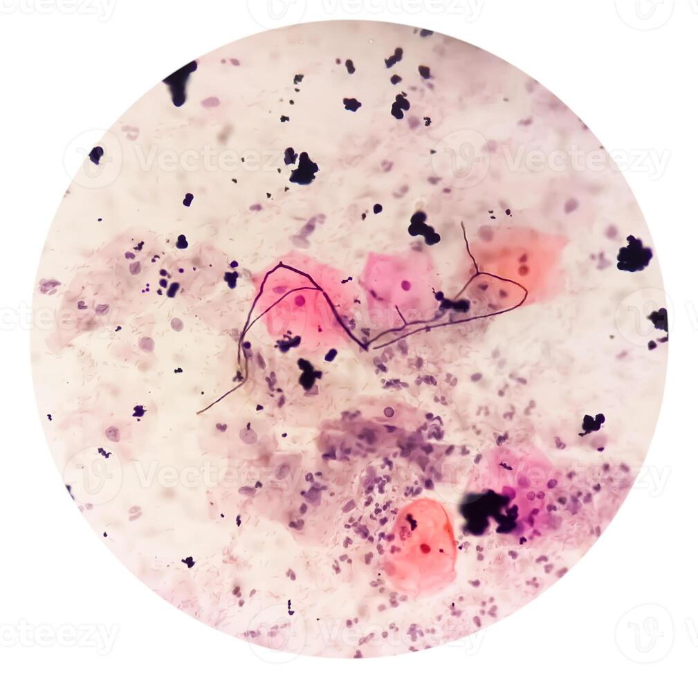 microfotografía de paparazzi frotis. inflamatorio frotis con vaginal candidiasis . médico concepto. foto