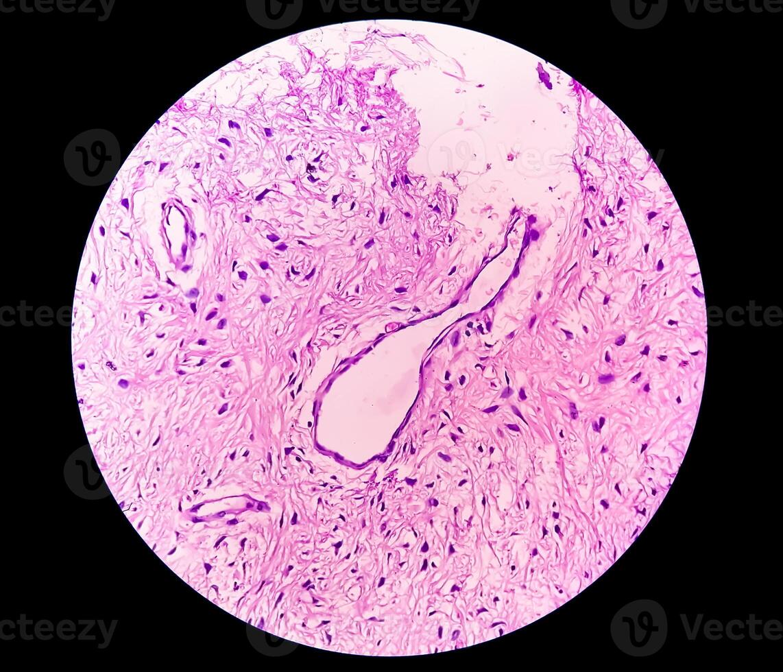 Leg tissue biopsy. Photomicrographic image showing Fibromyxoma. Superficial Acral Fibromyxoma, rare slow growing myxoid tumor. photo