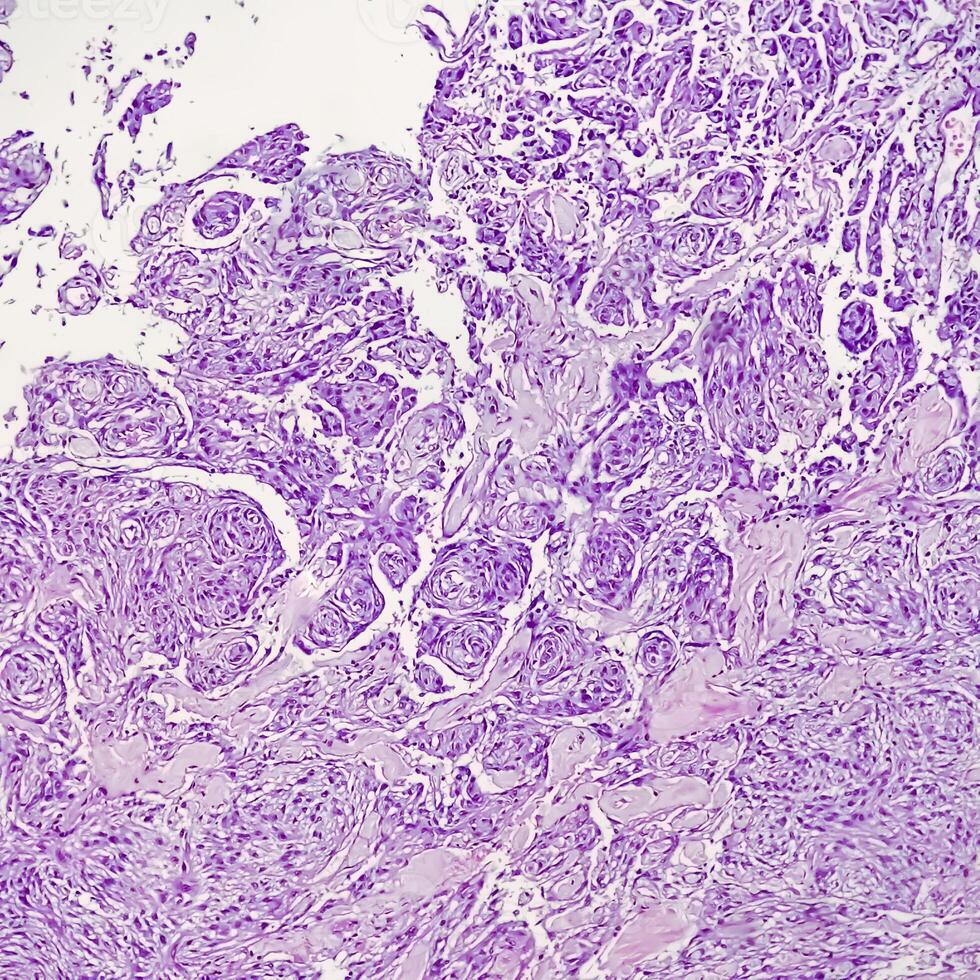 Histology, Peritoneal inclusion cyst. Paraovarian cysts, hydrosalpinx and low-grade cystic mesothelioma are usually considered in the differential diagnosis of PICs. photo