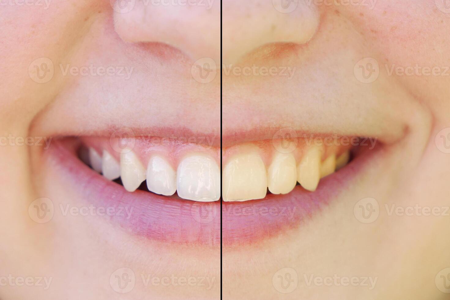 teeth whitening before and after photo