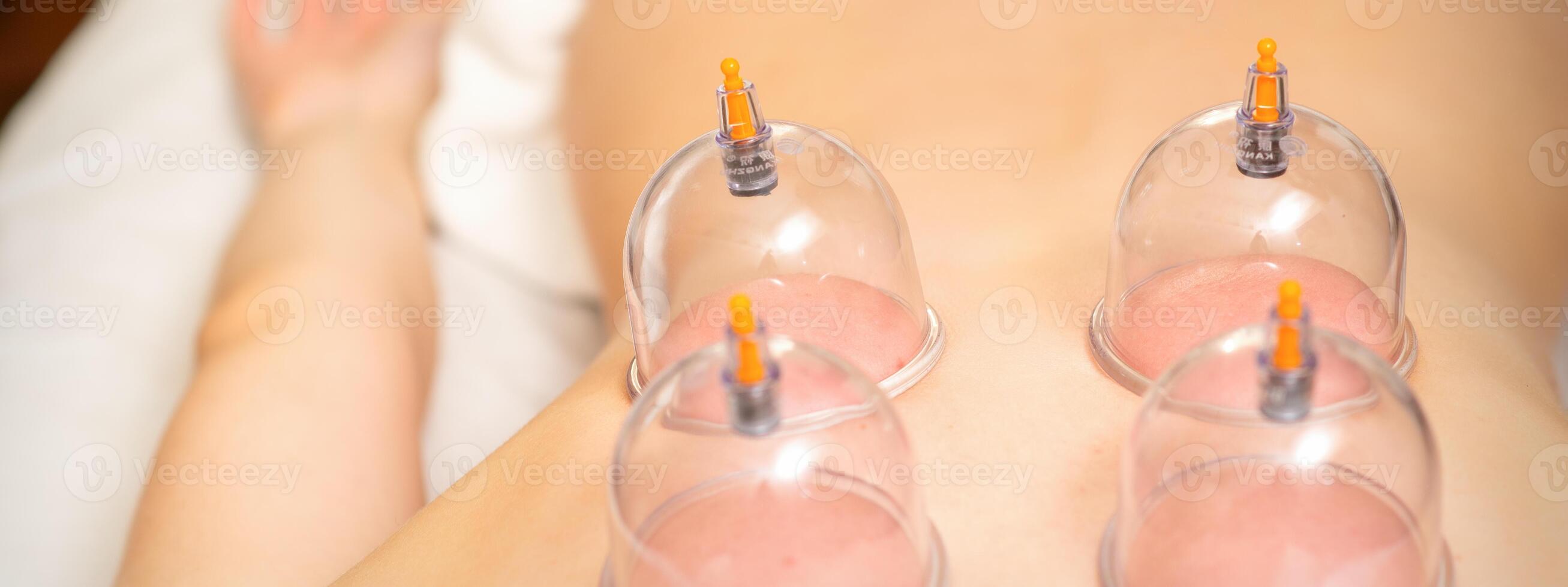 Young caucasian woman receiving cupping therapy in spa clinic. Islamic female medicine. photo