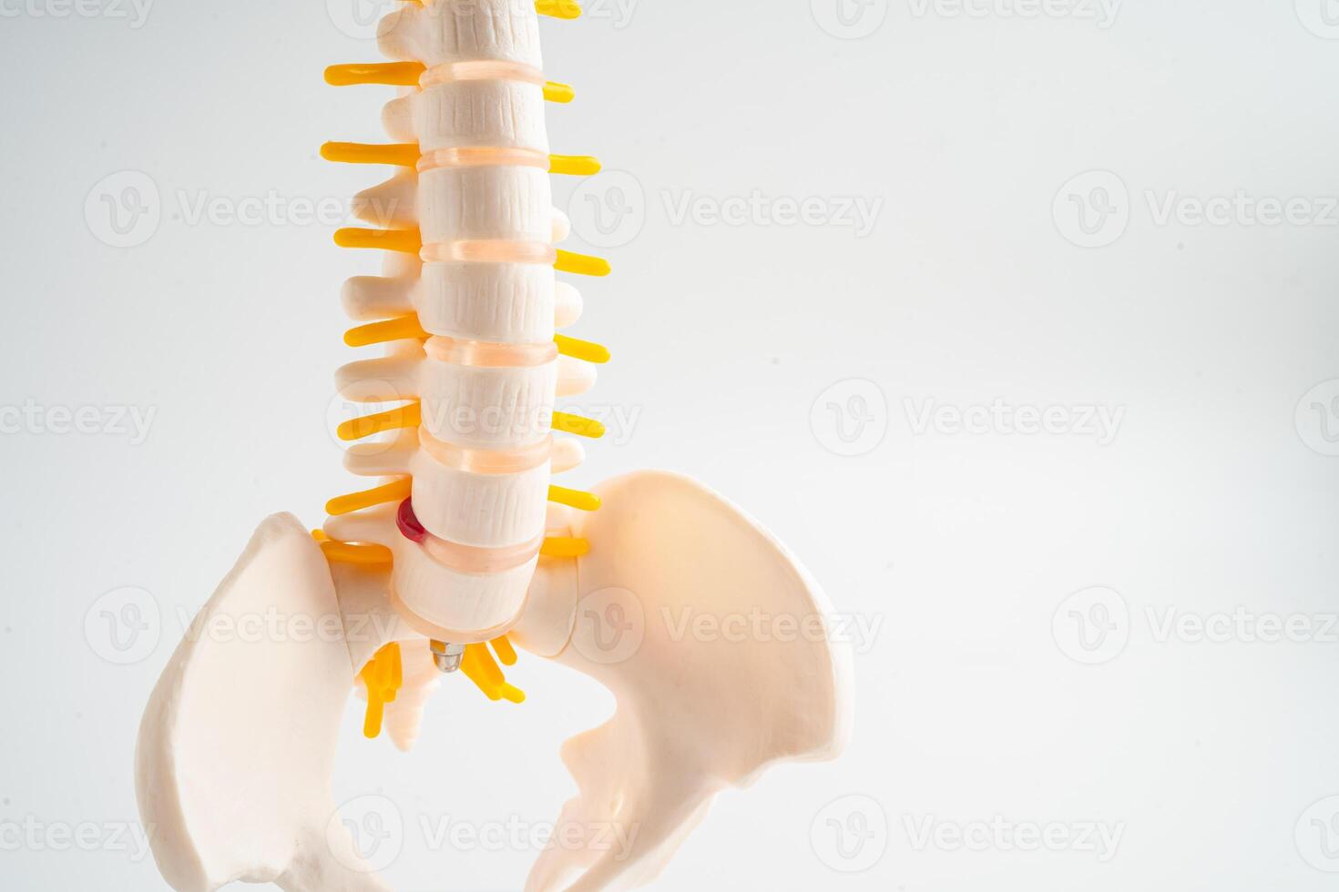 Lumbar spine displaced herniated disc fragment, spinal nerve and bone. Model for treatment medical in the orthopedic department. photo