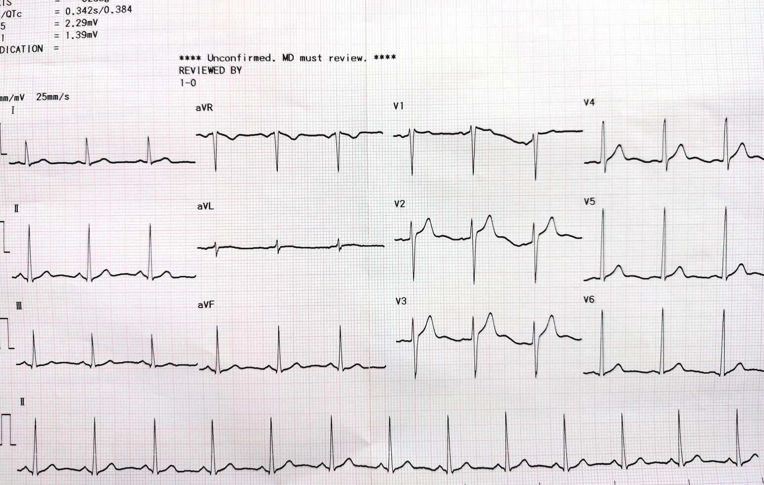 Graph showing the results of the electrocardiogram test on recording paper. photo