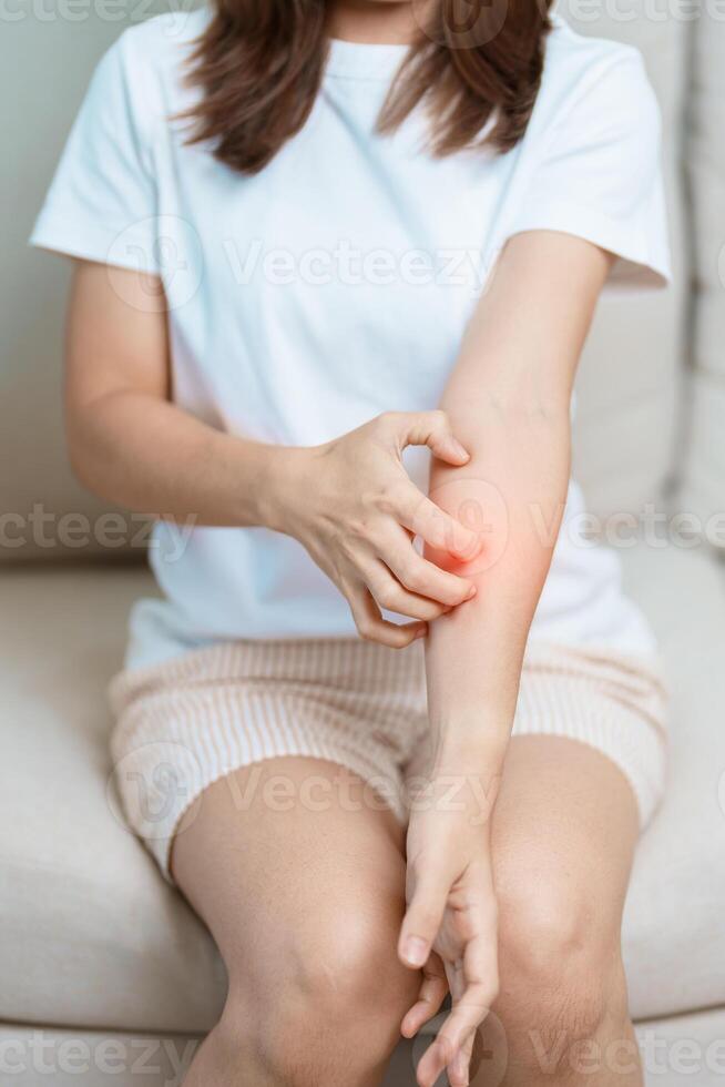 woman itching and scratching itchy arm. Sensitive Skin Allergic reaction to insect bite, food, drug dermatitis. Dermatology, Leprosy day, Systemic lupus erythematosus, Allergy symptoms and rash Eczema photo