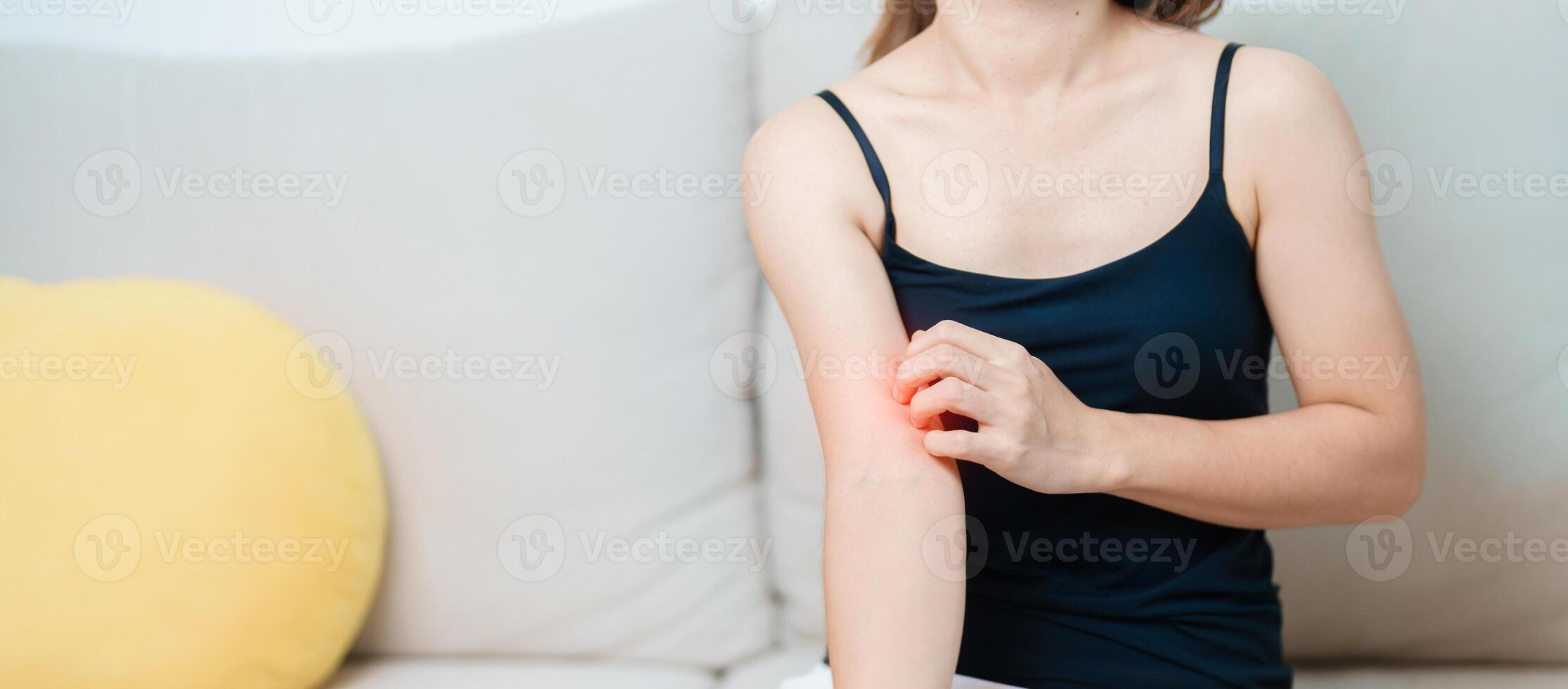 woman itching and scratching itchy arm. Sensitive Skin Allergic reaction to insect bite, food, drug dermatitis. Dermatology, Leprosy day, Systemic lupus erythematosus, Allergy symptoms and rash Eczema photo