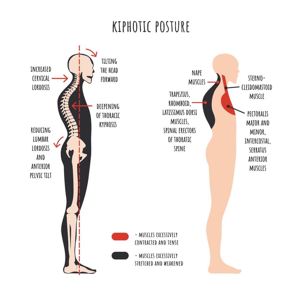 Kyphotic posture. The side view shows deformation of rounded shoulders, spine curvature, pelvis rotation, stretched and weakened, shortened and tens muscles. vector