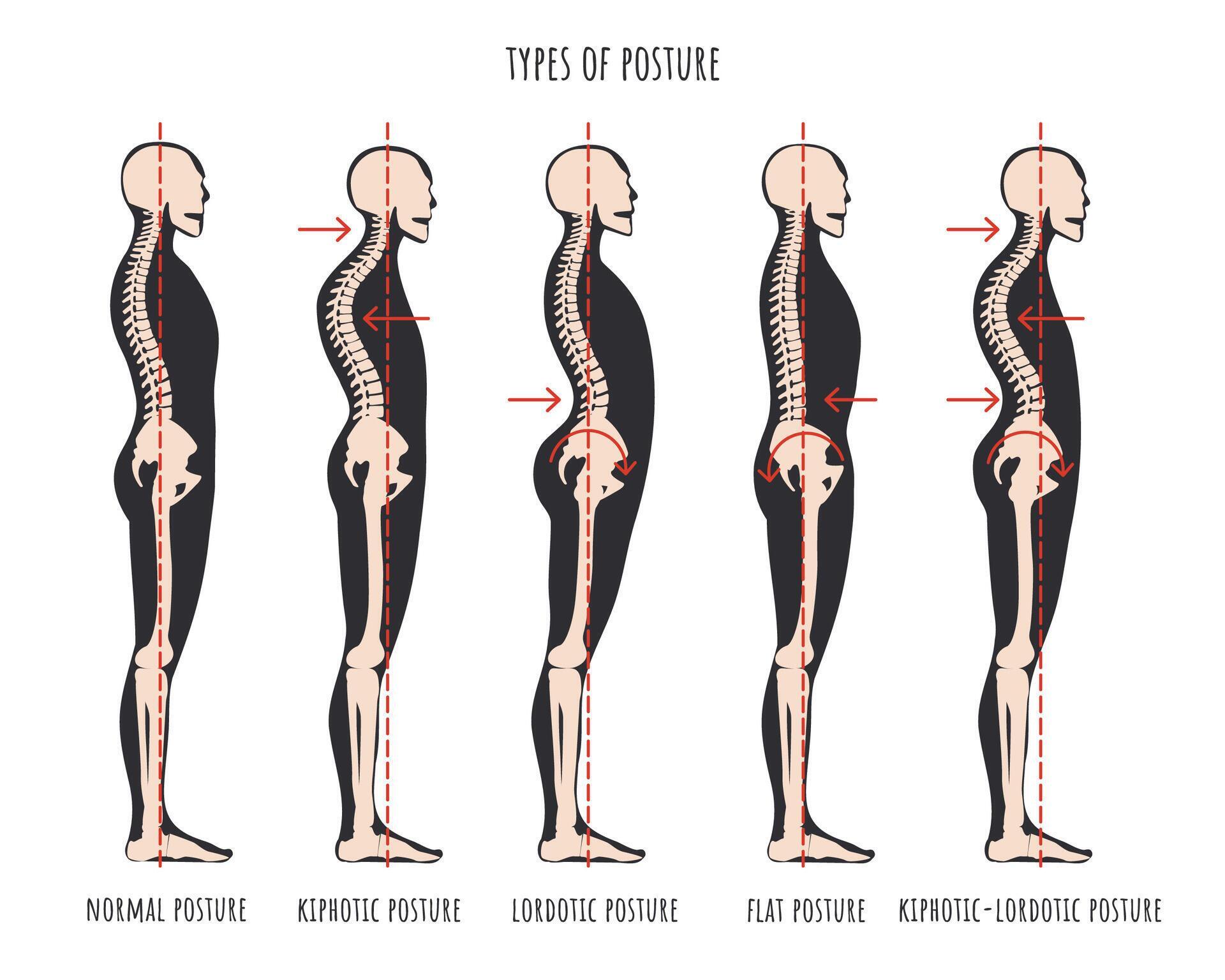 Type of posture postural syndromes infographic Skeletal samples of