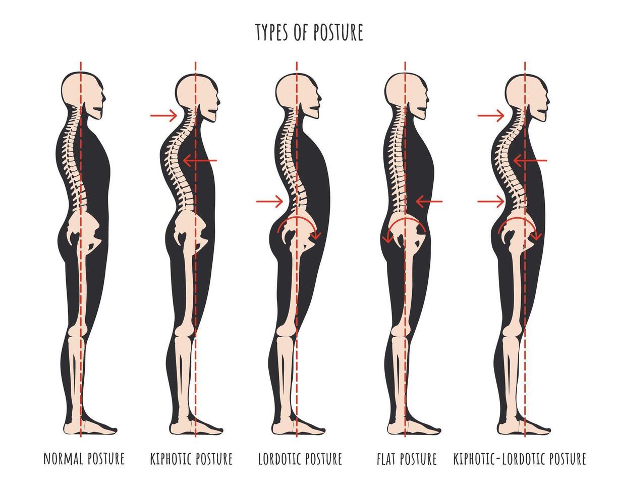 tipo de postura, postural síndromes infografía. esquelético muestras de espalda problema cifosis, lordosis y plano atrás. normal postura médico educativo póster. vector