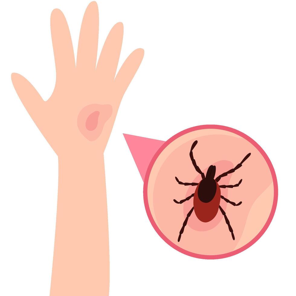 el humano mano con el garrapata morder. garrapata mordedura mano.tick morder. cuidado de la salud ilustración. vector