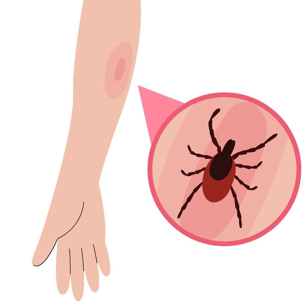 The human hand with the tick bite. Tick bite hand.Tick bite. Healthcare illustration. vector