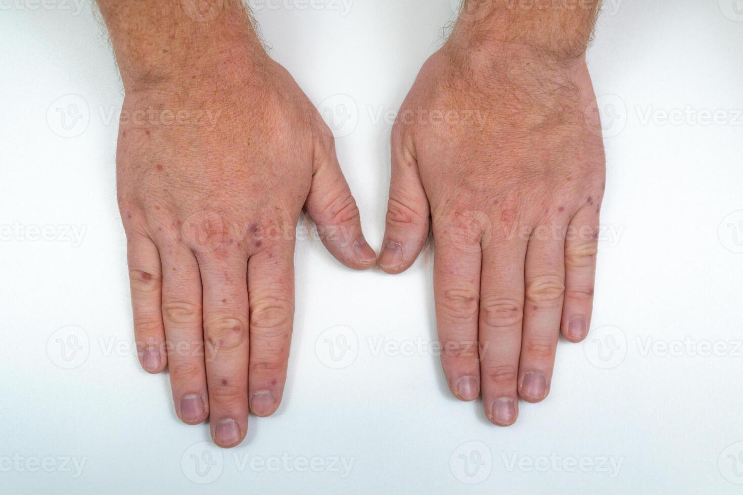 Painful rash, red blisters on a man's arm. Human hands with dermatitis, allergy rash. Enterovirus. Coxsackie virus. Allergic rash on the hands of an adult man photo