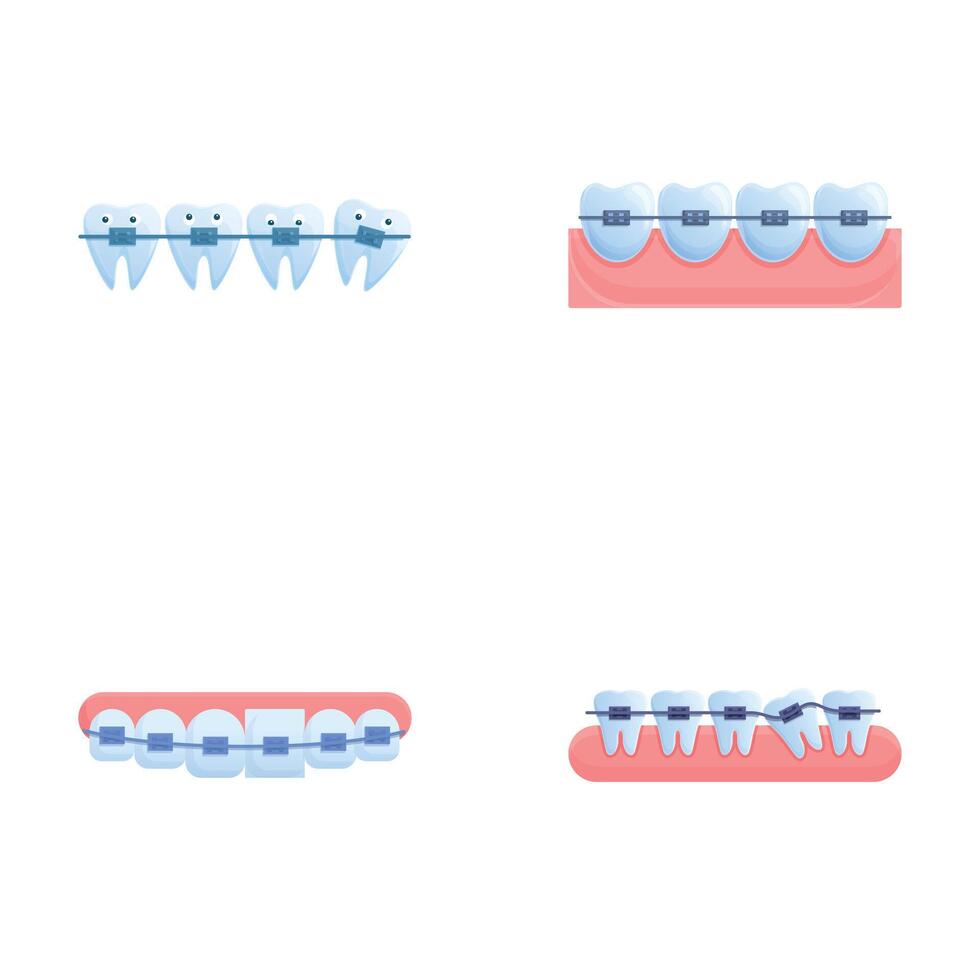 Orthodontic treatment icons set cartoon . Various brace system on teeth vector