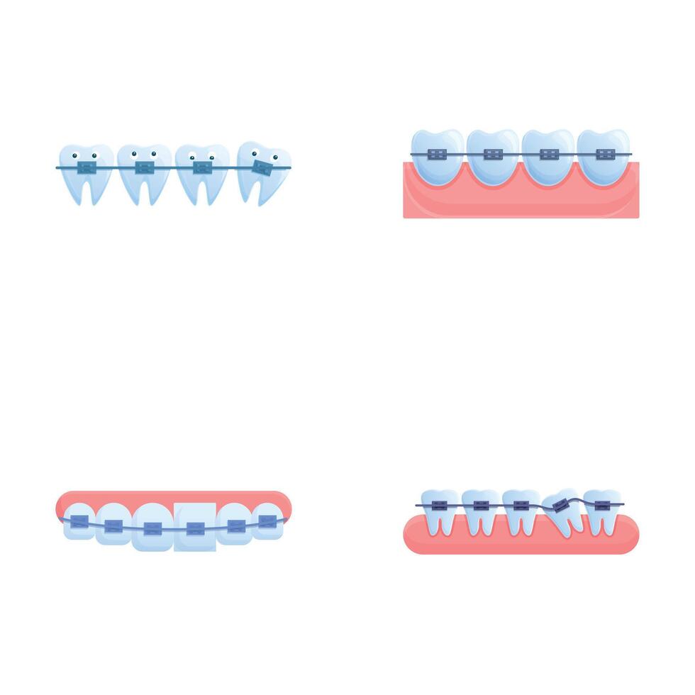 Orthodontic treatment icons set cartoon . Various brace system on teeth vector