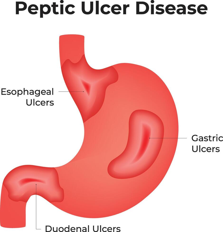 Peptic Ulcer Disease Science Design Illustration. vector