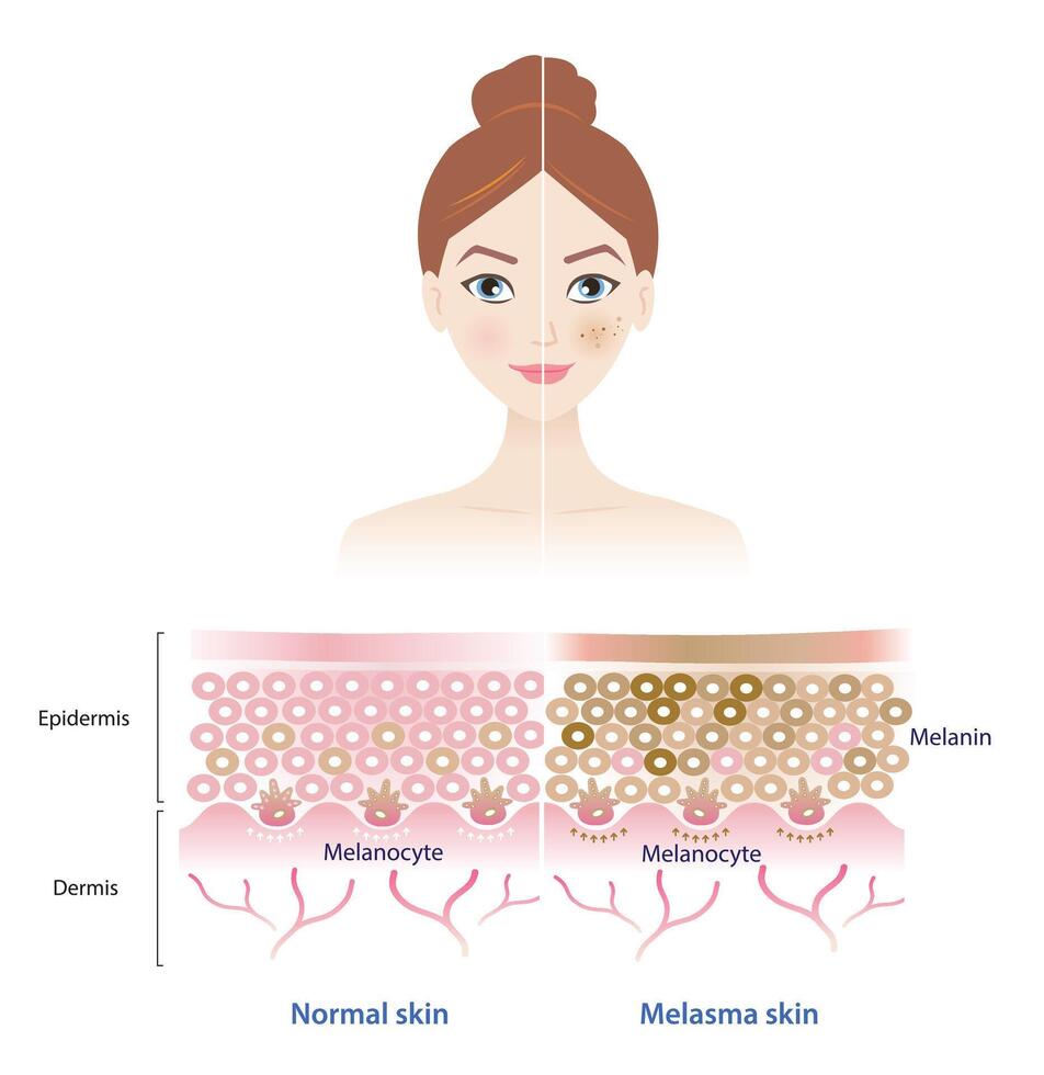 infografía de normal y melasma piel en mujer cara ilustración. comparación de sano epidermis piel capa, hiperpigmentación, melasma y oscuro lugares. piel cuidado y belleza concepto. vector