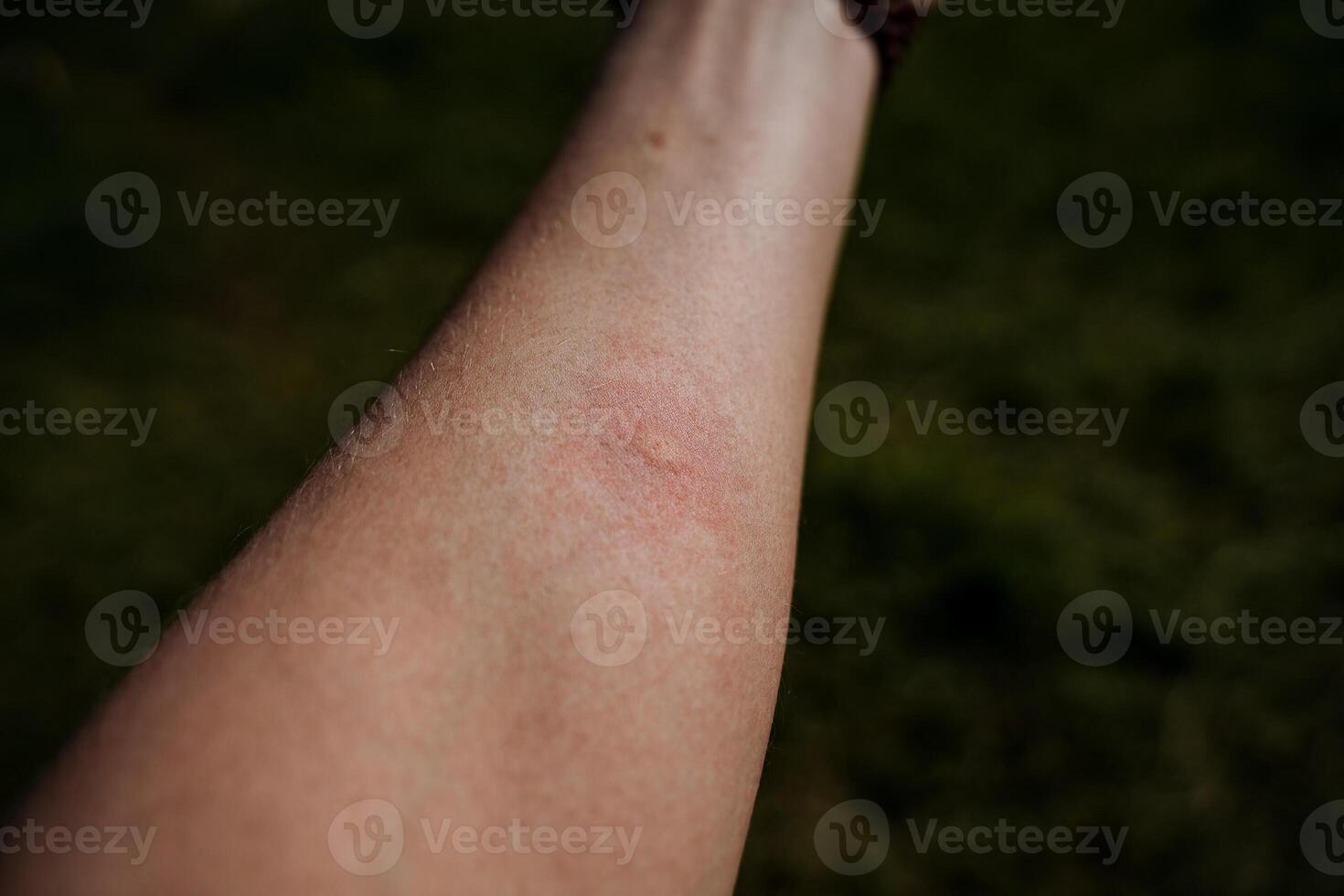 A blister mark from a midge bite on the human body, a red spot from a mosquito bite, reddening of the skin, itching on the body. photo