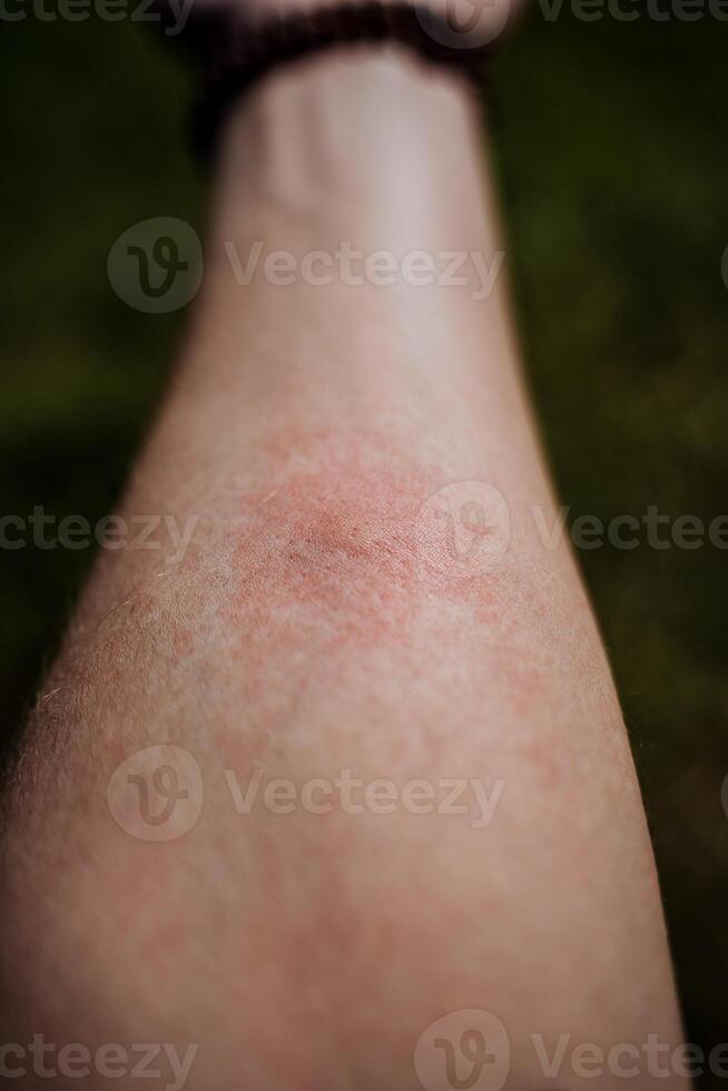rojo Mancha desde un mosquito morder, hinchazón de el piel después un mosquito morder, irritación alergia a insectos foto