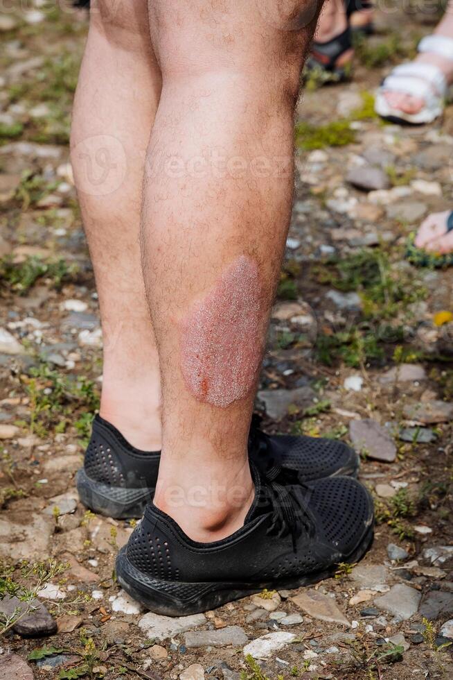 Eczema on the skin, damage to the upper layer of the skin, irritation dryness, burn on the leg, allergy to a bee sting, dermatological disease, lichen itches. photo