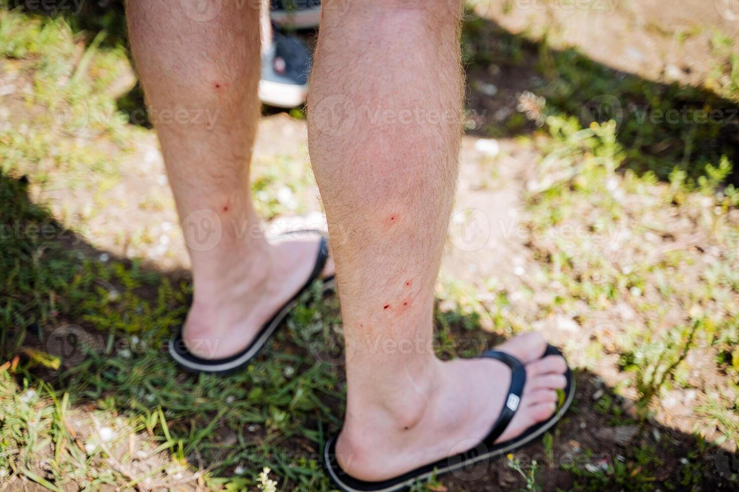 Red dots on human legs, bites of small blood-sucking insects, damage to the skin, itching and irritation of blisters, midge bite, pain in the legs. photo