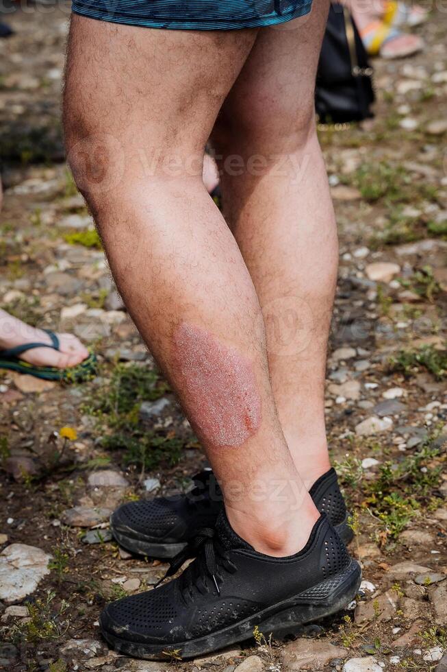 Manifestation of an allergic reaction on human skin, eczema skin disease, dryness irritation thermal burn, damaged leg, dermatological rash photo