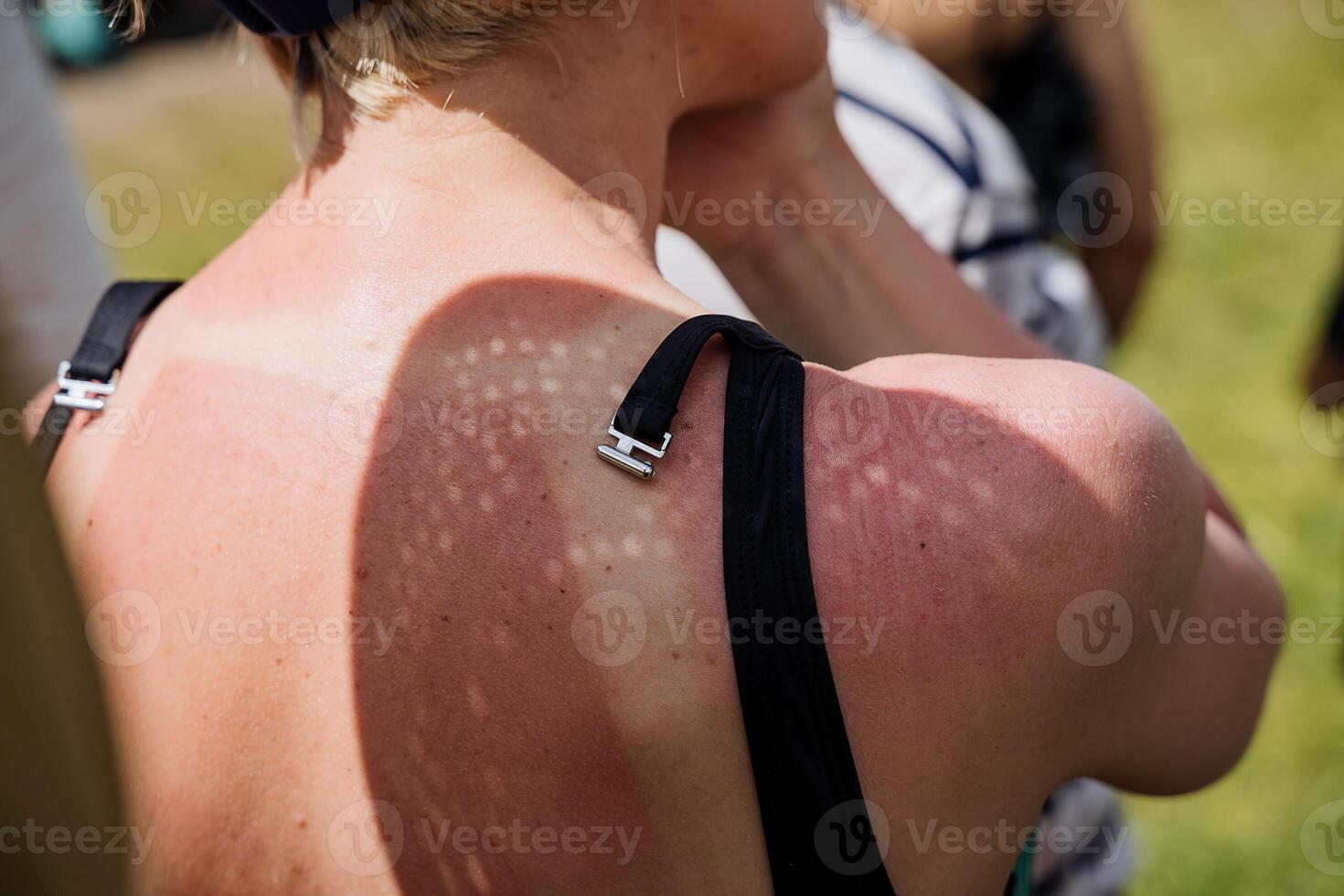 The girl's back was burned in the sun, tan marks from the bright sun, the bra clasp, the view from the back of a person on vacation, summer holidays at sea. photo