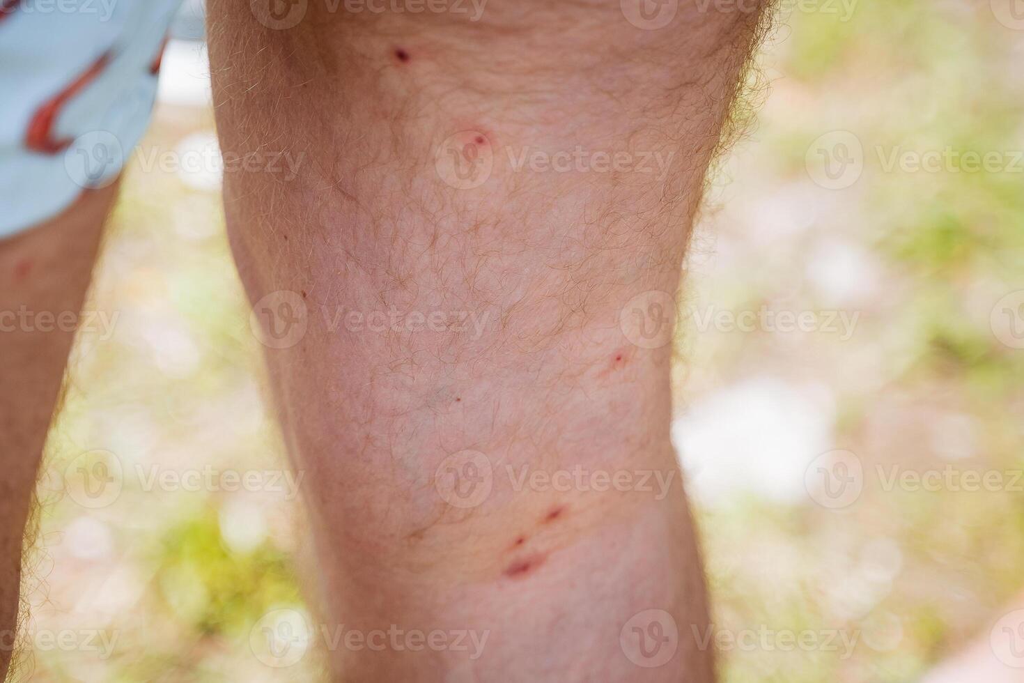 el pierna en rojo puntos insecto muerde, enrojecimiento de el piel después mosquitos, mosquito mordedura irritación, Mancha pica foto