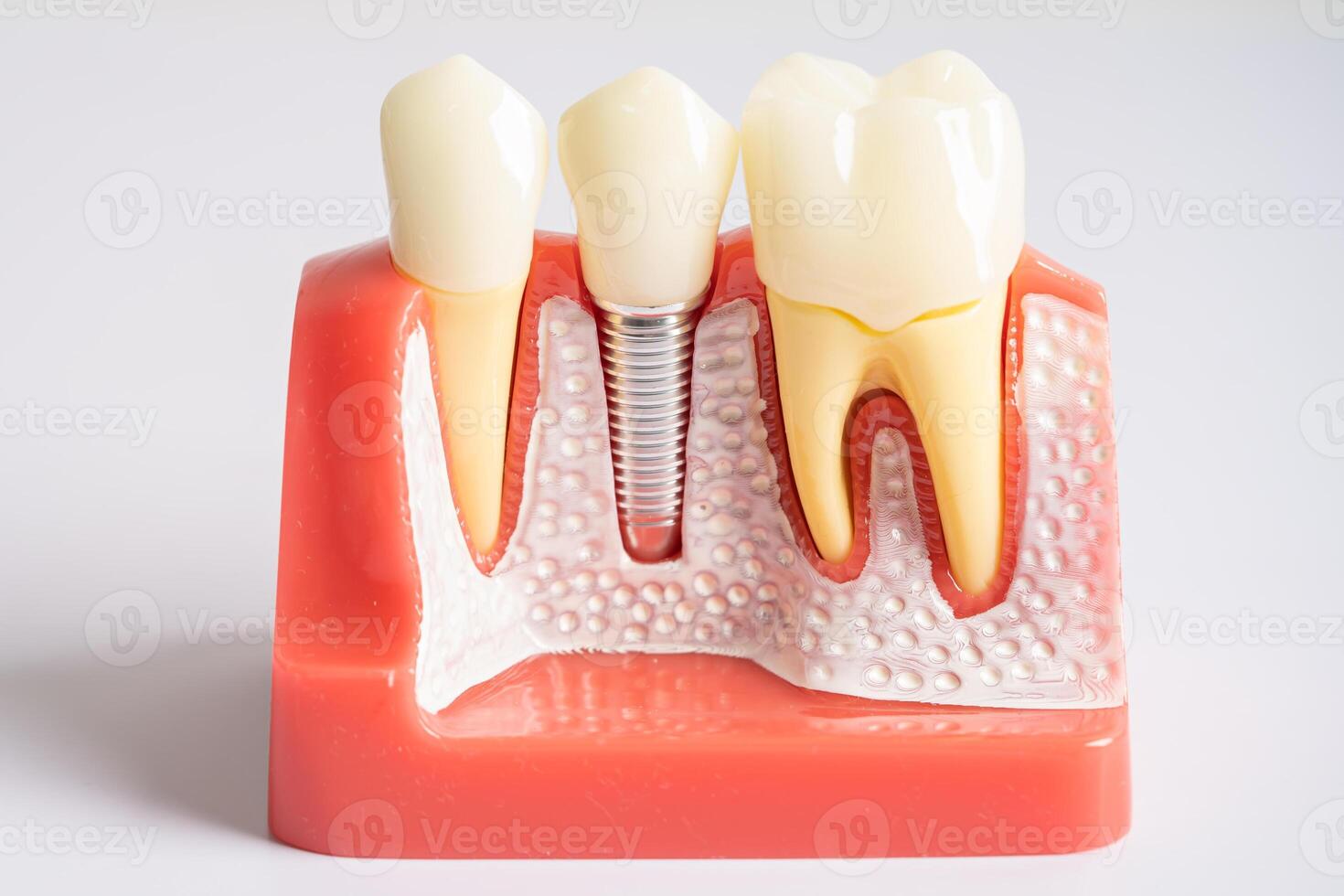 Dental implant, artificial tooth roots into jaw, root canal of dental treatment, gum disease, teeth model for dentist studying about dentistry. photo