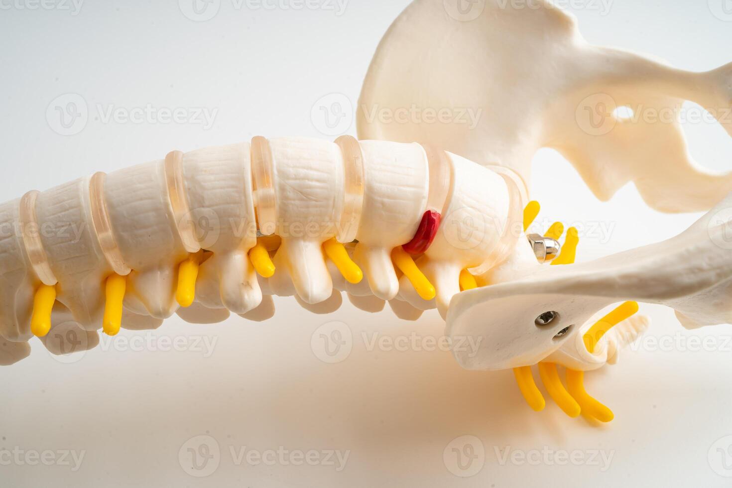 lumbar espina desplazado herniado Dto fragmento, espinal nervio y hueso. modelo para tratamiento médico en el ortopédico departamento. foto