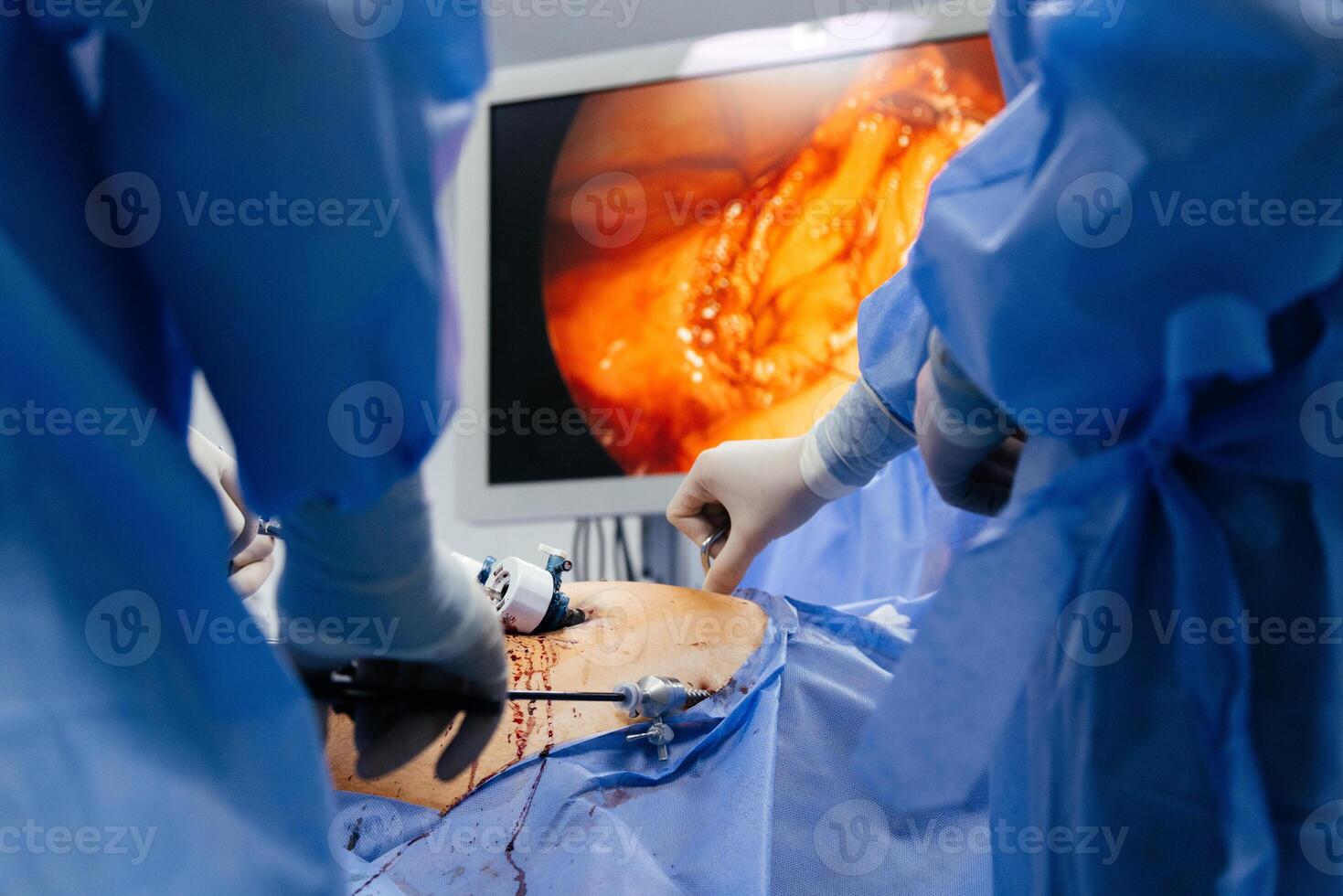 Doctor in blue sterile surgical gown doing surgery with camera and instrument. Keyhole surgery was perform in modern operating room. Advanced laparoscopy photo