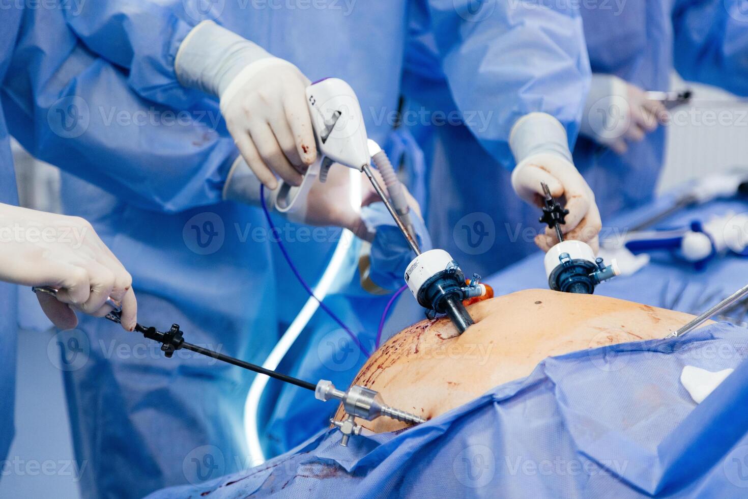 Doctor in blue sterile surgical gown doing surgery with camera and instrument. Keyhole surgery was perform in modern operating room. Advanced laparoscopy photo