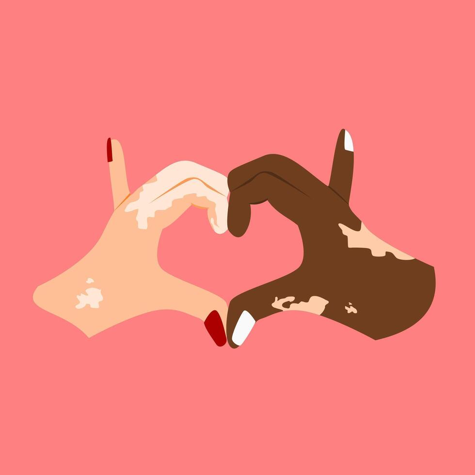 Illustration of two hands forming a heart with both hands suffering from vitiligo vector