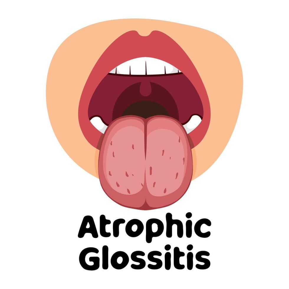 Atrophic Glossitis llustration vector