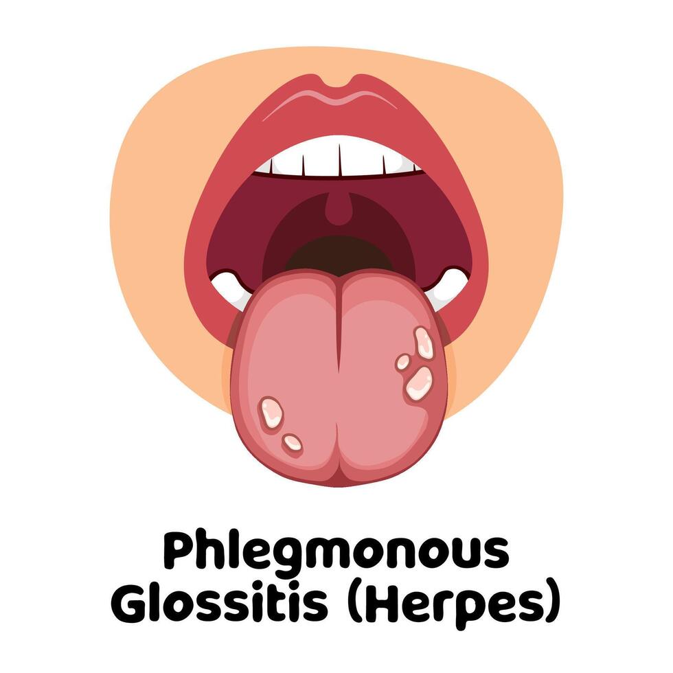 Phlegmonous Glossitis Herpes illustration vector