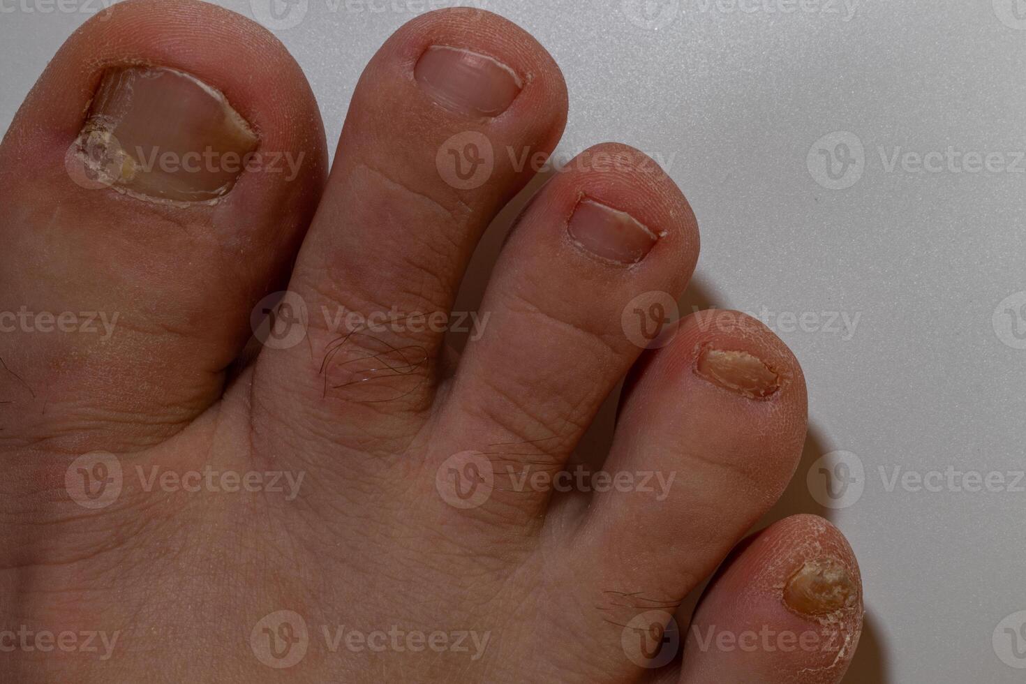 fungal nail infection Onychomycosis. dry coarse skin of the legs photo