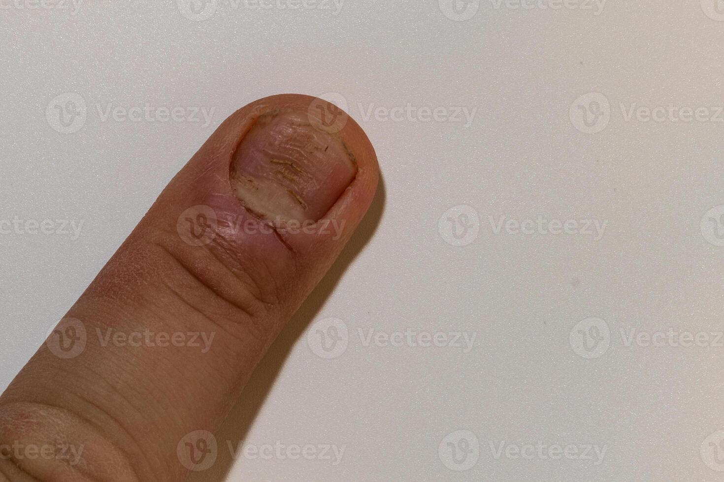 fungal nail infection Onychomycosis. dry coarse skin of the legs photo