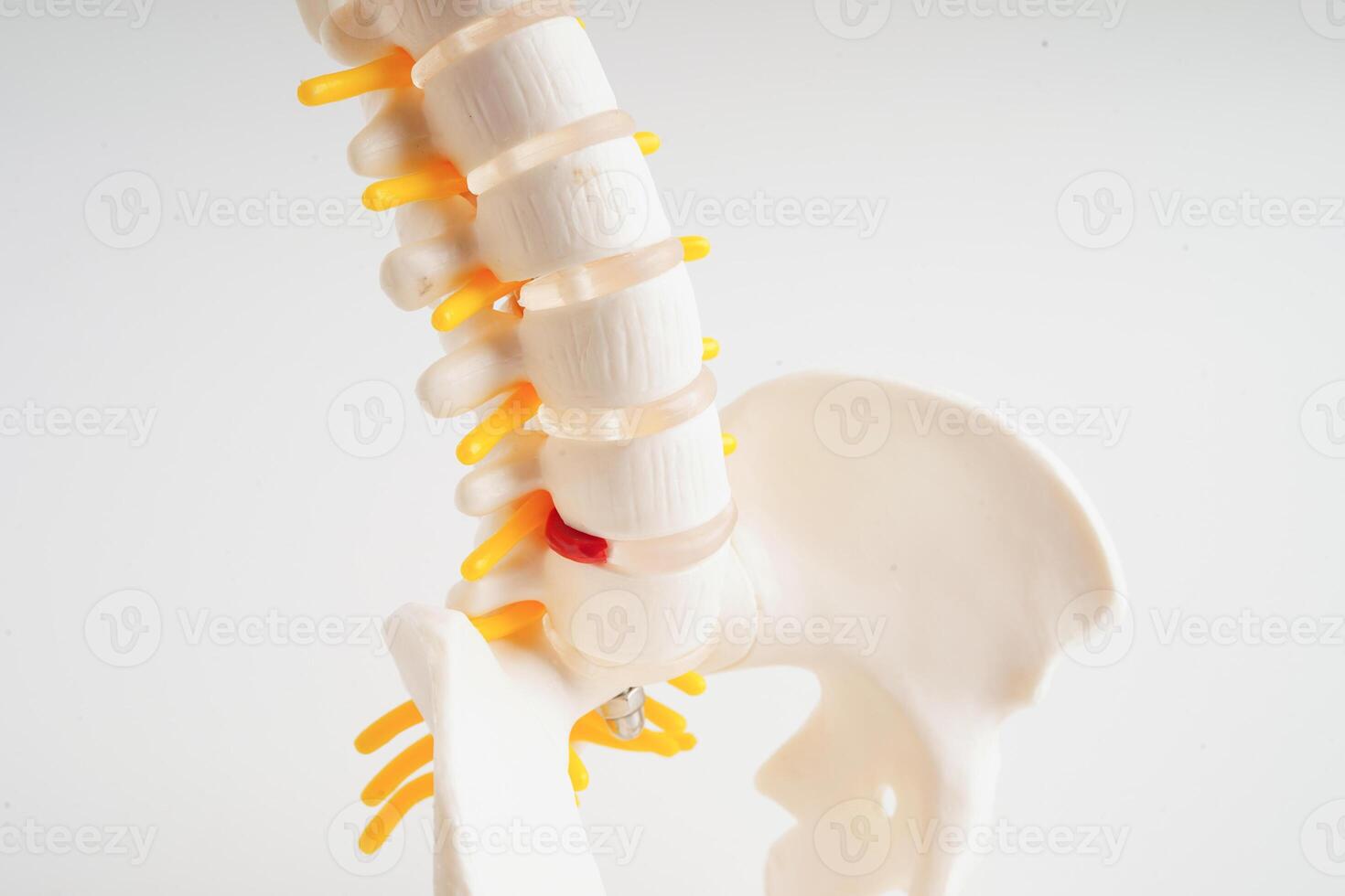 espinal nervio y hueso, lumbar espina desplazado herniado Dto fragmento, modelo para tratamiento médico en el ortopédico departamento. foto