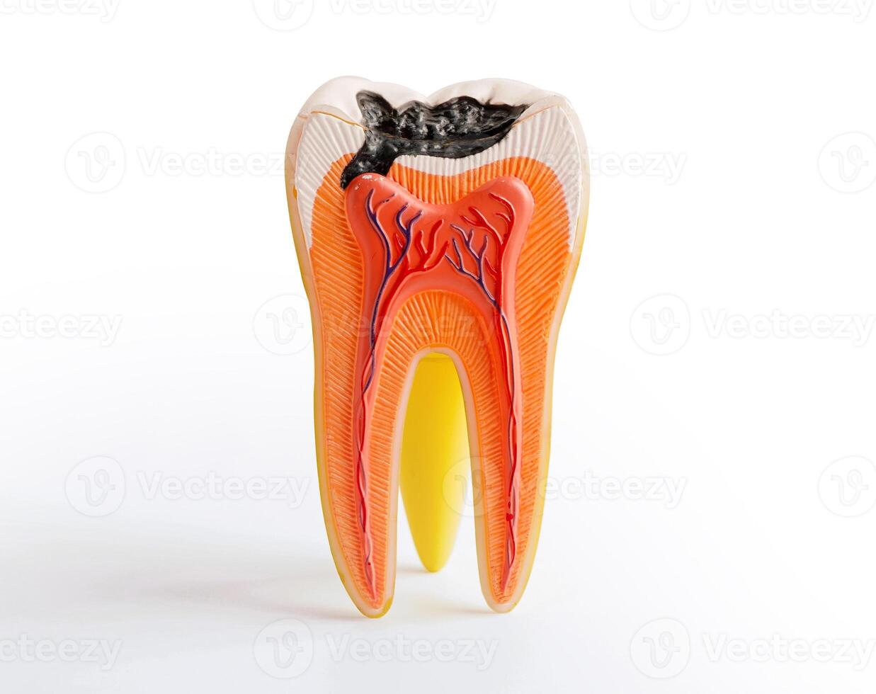 Decay tooth replace with dental implant root canal teeth model for education isolated on white background with clipping path. photo