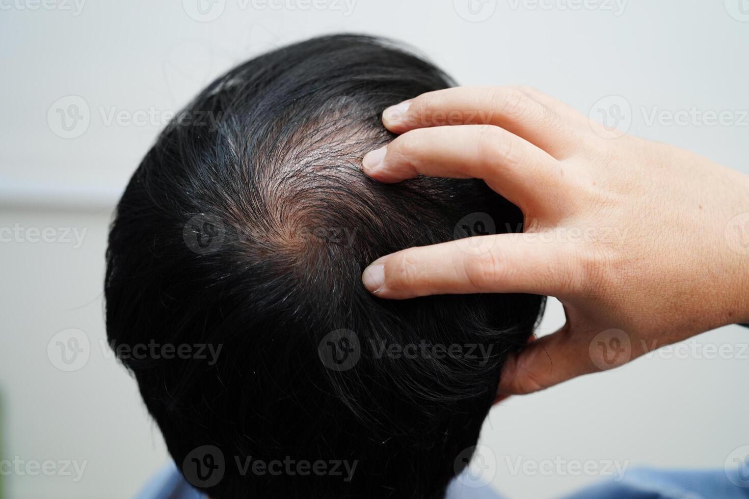 calvo cabeza en hombre, pelo pérdida tratamiento salud problema. foto