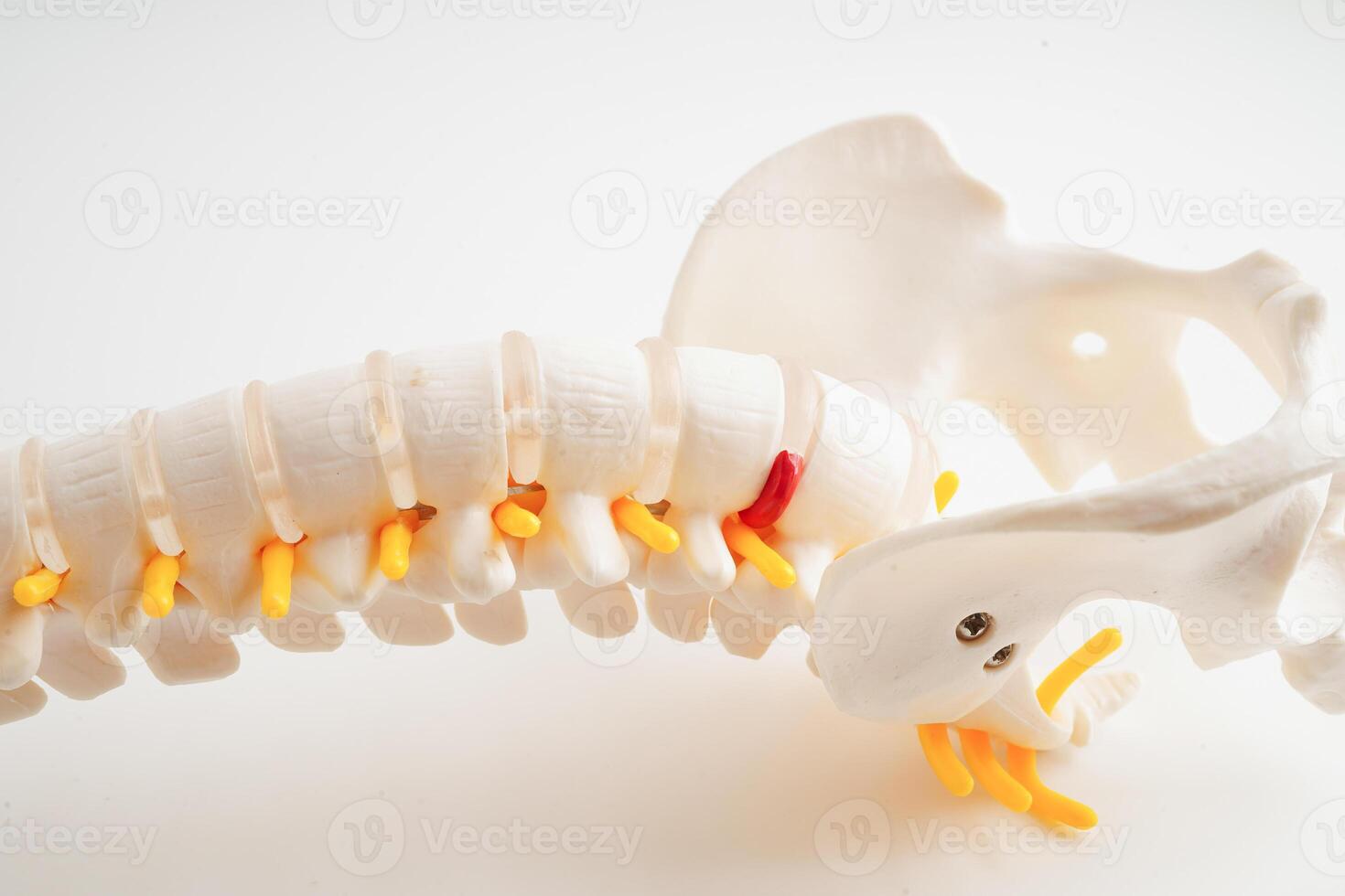Spinal nerve and bone, Lumbar spine displaced herniated disc fragment, Model for treatment medical in the orthopedic department. photo