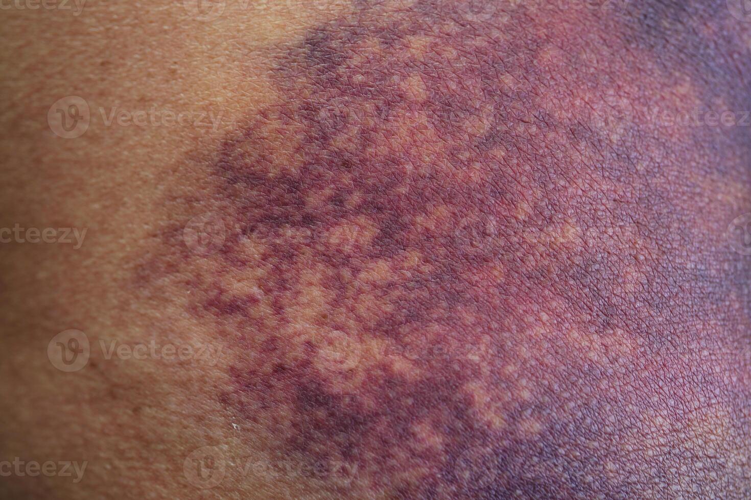 Bruise on the buttock skin injury from accident at home. photo