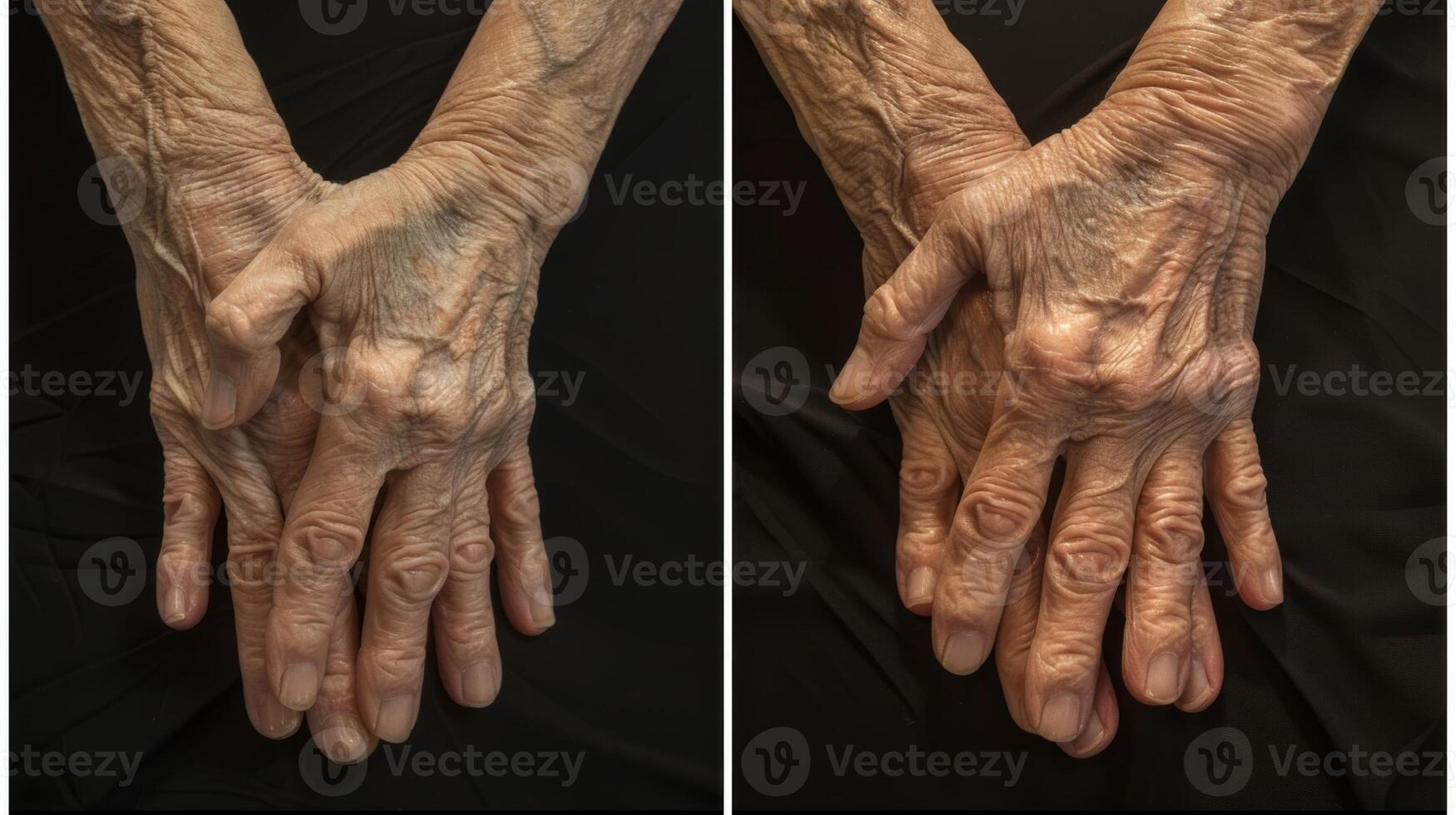 A before and after photo showcasing the significant improvement in range of motion and reduced swelling in the hands of an arthritis patient who regularly uses the theutic sauna.