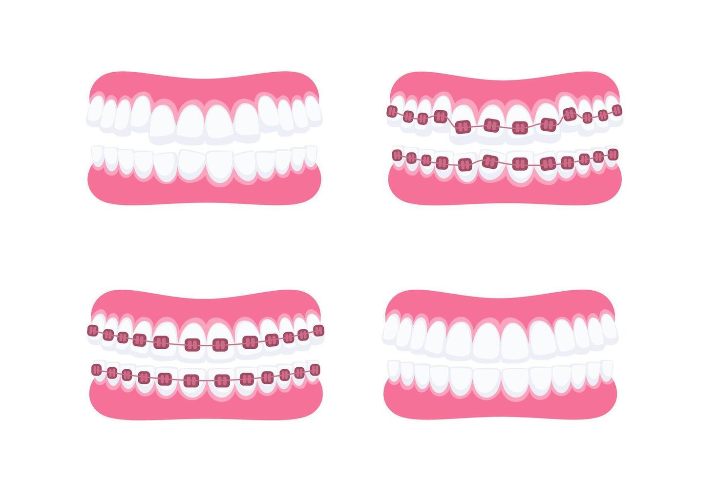 Teeth with braces. Orthodontic treatment. Tooth braces. Teeth with metal brackets vector