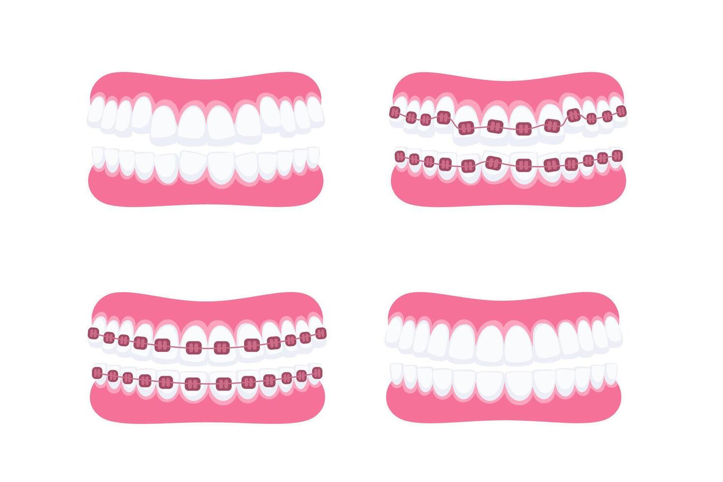 dientes con tirantes. ortodoncia tratamiento. diente tirantes. dientes con metal soportes vector