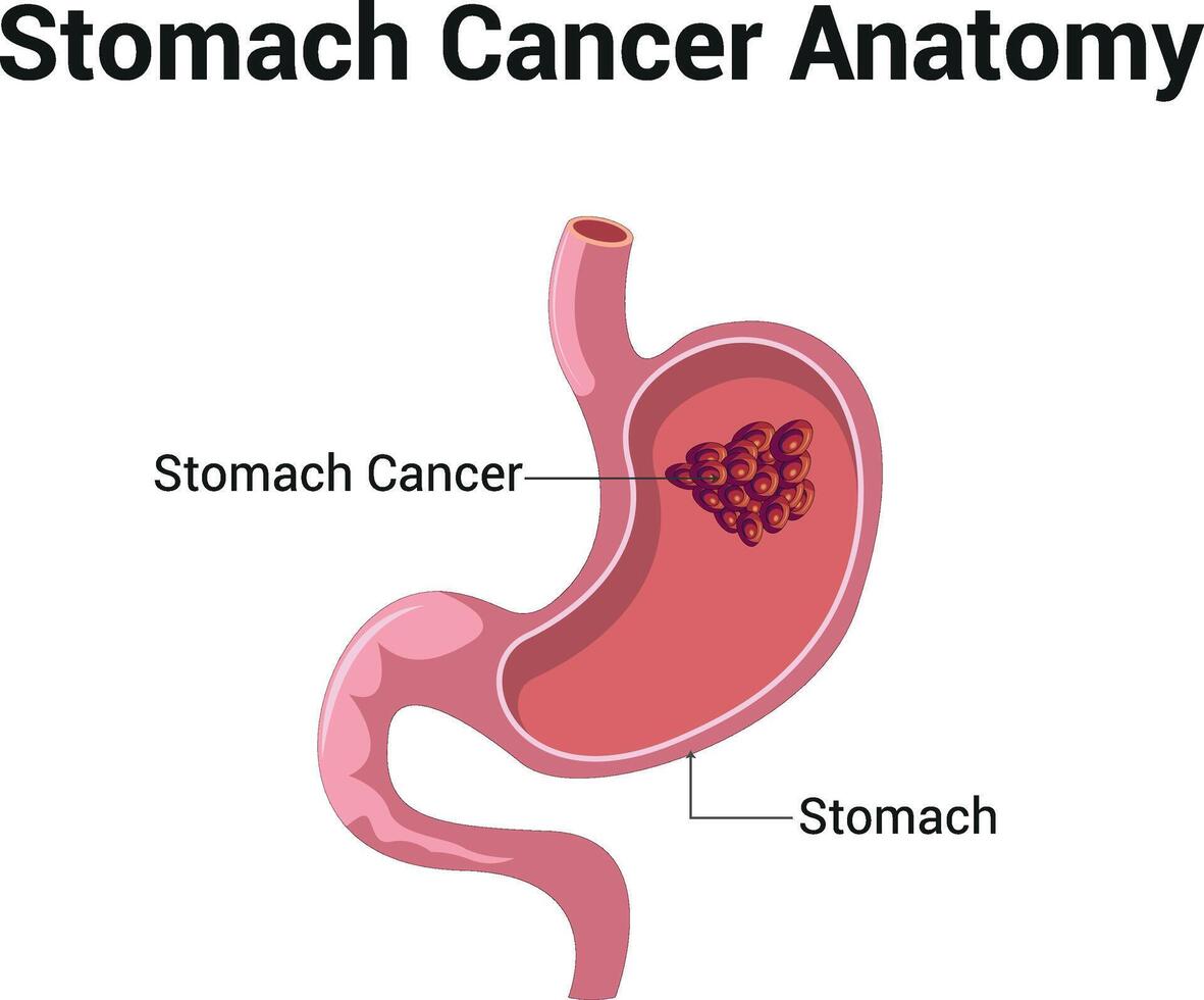 estómago cáncer anatomía Ciencias diagrama ilustración vector